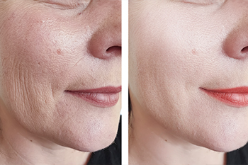 Laser Skin Rejuvenation